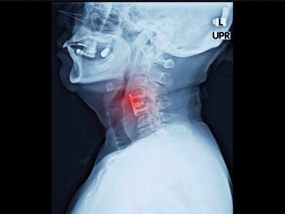 Herniated Disc - AKSIS Special Hospital