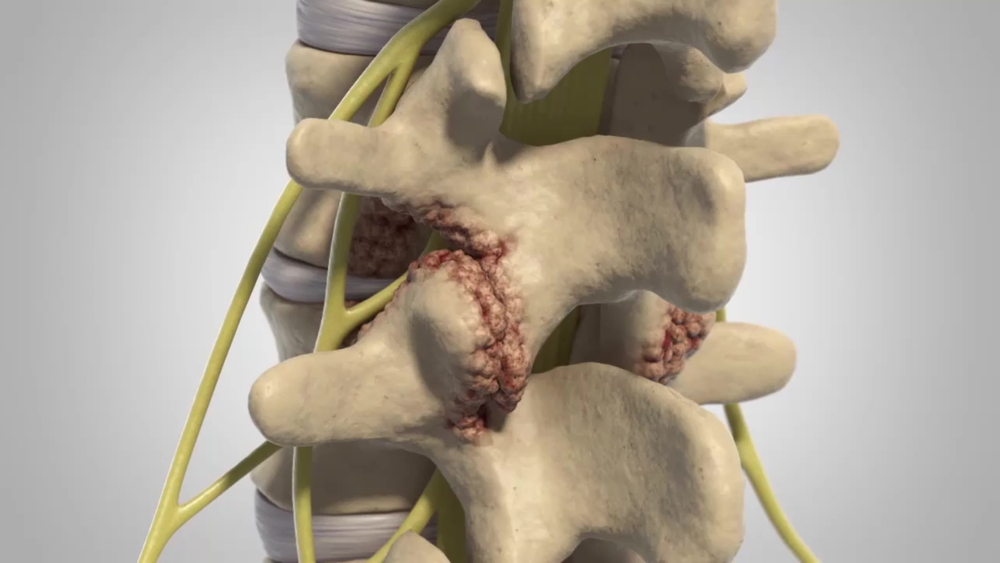 Bone Spurs and Osteophytes - AKSIS Special Hospital