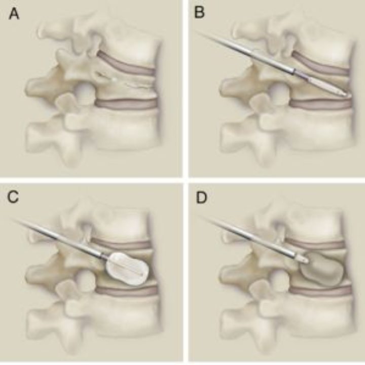 Kyphoplasty and Vertebroplasty - AKSIS Special Hospital